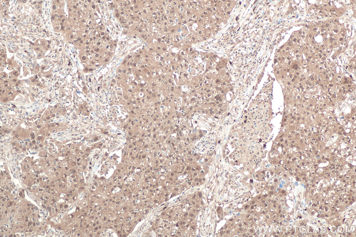 Immunohistochemical analysis of paraffin-embedded human lung cancer tissue slide using KHC0836 (PPIL1 IHC Kit).