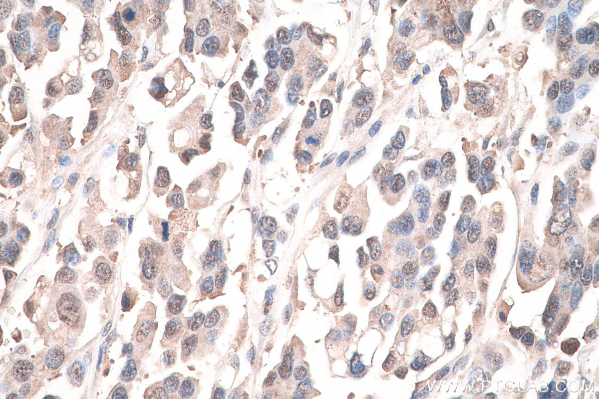 Immunohistochemical analysis of paraffin-embedded human colon cancer tissue slide using KHC0837 (PPIL3 IHC Kit).