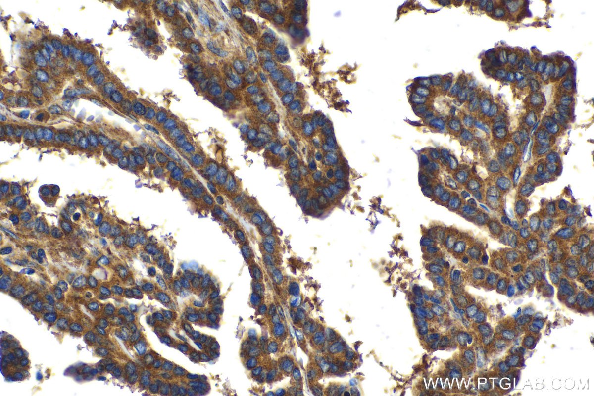 Immunohistochemical analysis of paraffin-embedded human thyroid cancer tissue slide using KHC2070 (PPM1D IHC Kit).