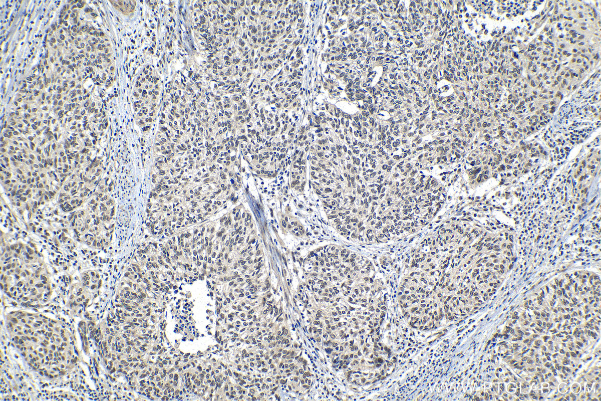 Immunohistochemical analysis of paraffin-embedded human cervical cancer tissue slide using KHC1302 (PPM1G IHC Kit).