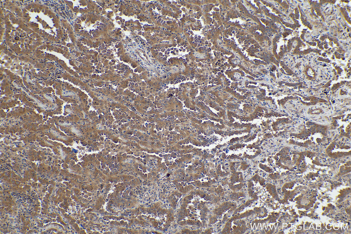 Immunohistochemical analysis of paraffin-embedded human lung cancer tissue slide using KHC0850 (PPP1CB IHC Kit).