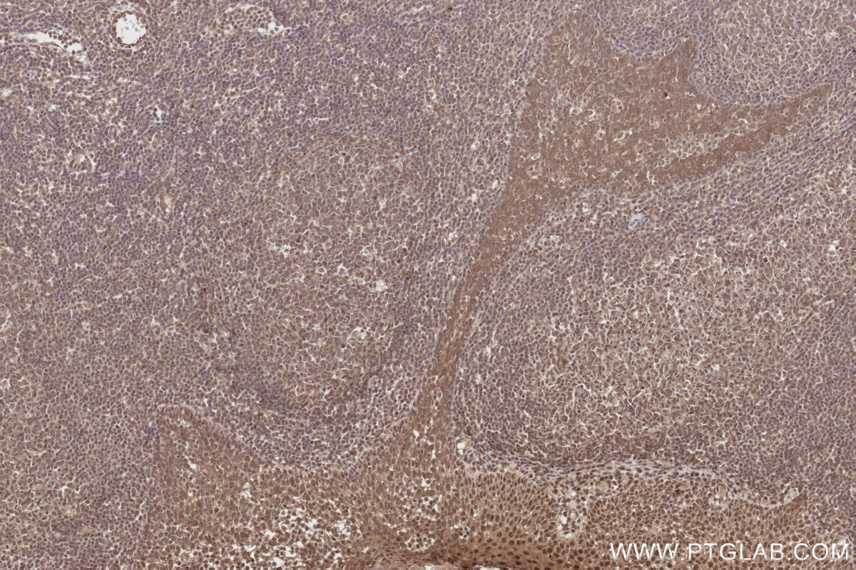 Immunohistochemical analysis of paraffin-embedded human tonsillitis tissue slide using KHC2805 (PPP1R13B IHC Kit).