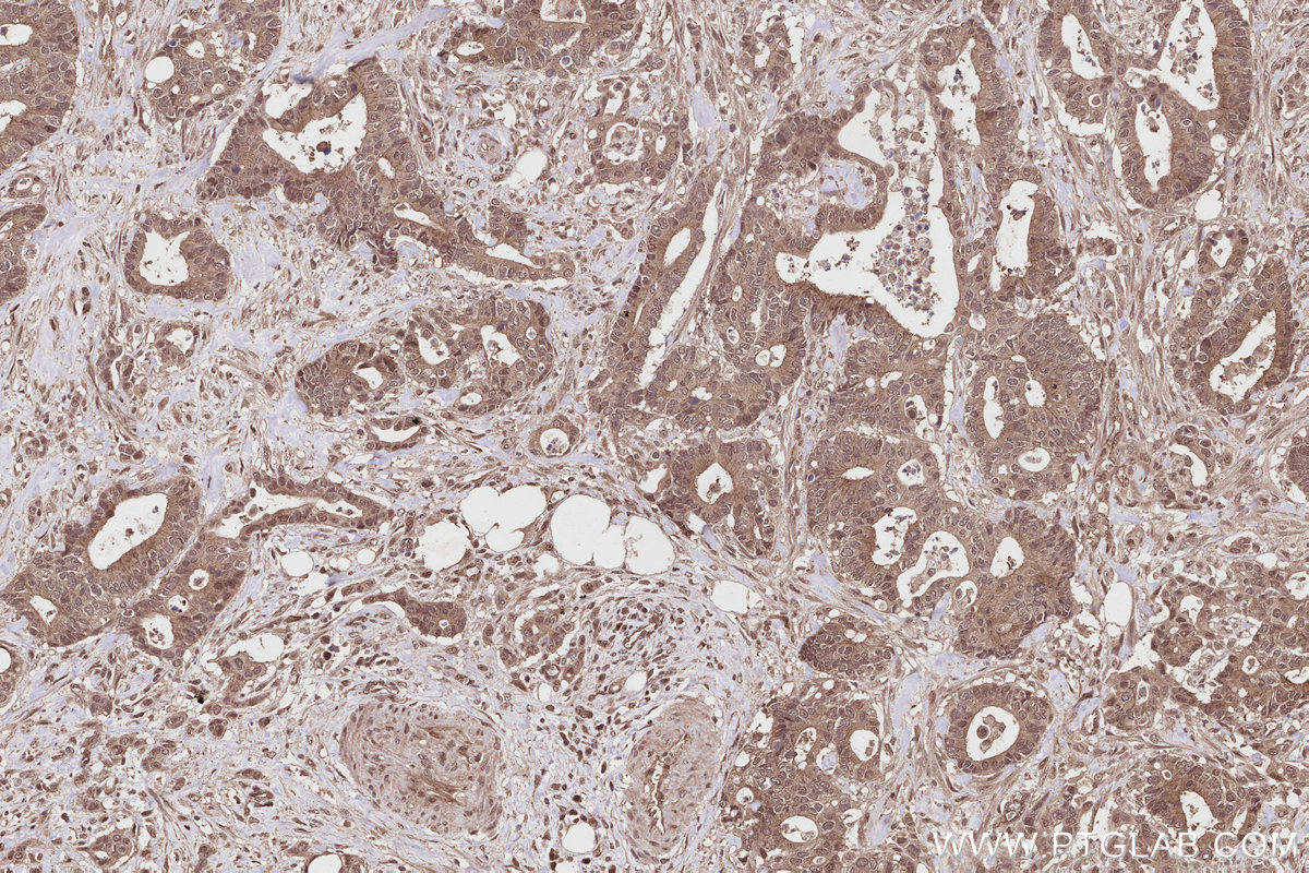 Immunohistochemical analysis of paraffin-embedded human rectal cancer tissue slide using KHC2805 (PPP1R13B IHC Kit).
