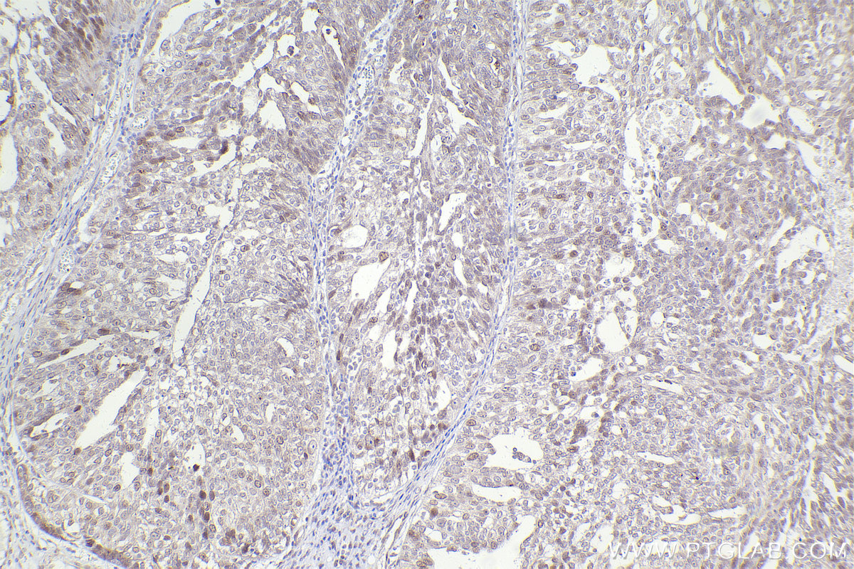Immunohistochemical analysis of paraffin-embedded human ovary cancer tissue slide using KHC2425 (PPP2R5C IHC Kit).