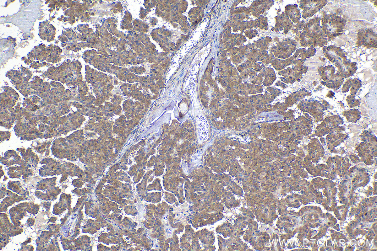 Immunohistochemical analysis of paraffin-embedded human thyroid cancer tissue slide using KHC1027 (PPP3CA IHC Kit).