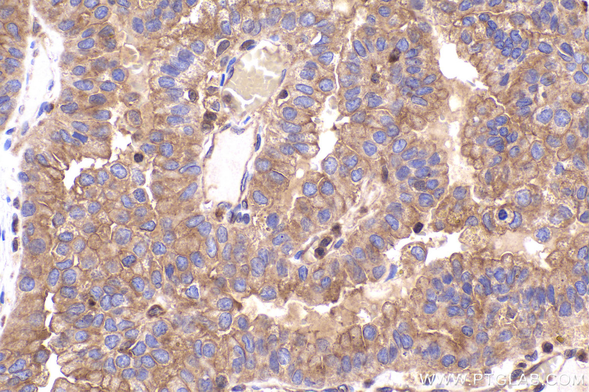 Immunohistochemical analysis of paraffin-embedded human renal cell carcinoma tissue slide using KHC2358 (PPP3R1 IHC Kit).