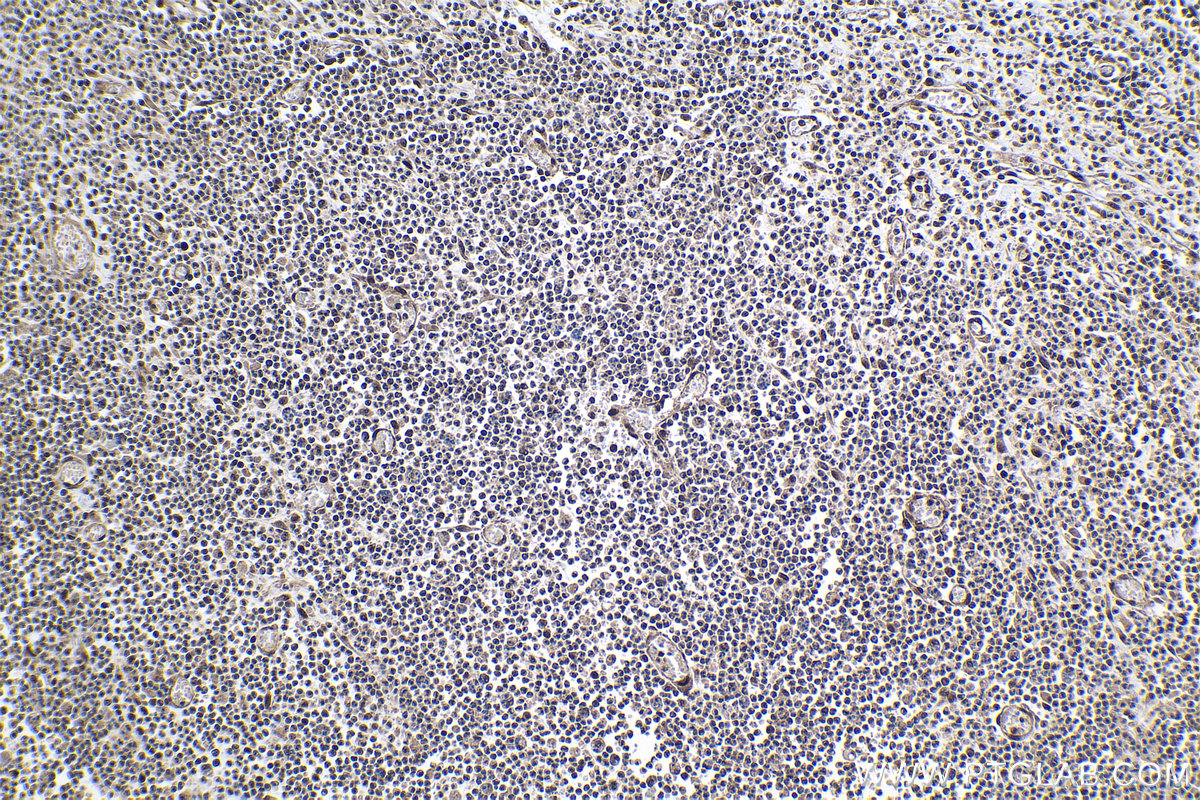 Immunohistochemical analysis of paraffin-embedded human colon cancer tissue slide using KHC1002 (PPP4C IHC Kit).