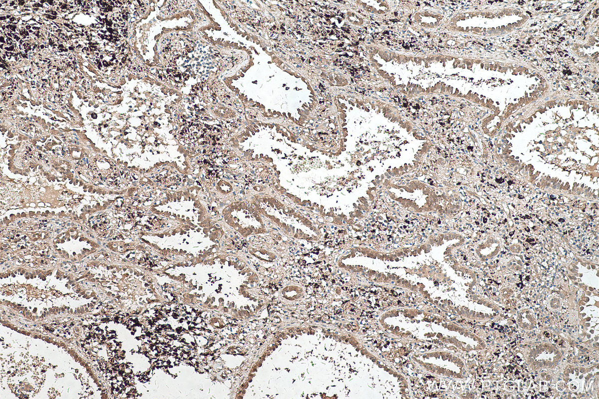 Immunohistochemical analysis of paraffin-embedded human lung cancer tissue slide using KHC0513 (PRDX6 IHC Kit).