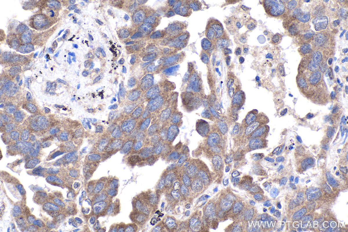 Immunohistochemical analysis of paraffin-embedded human lung cancer tissue slide using KHC1948 (PREB IHC Kit).