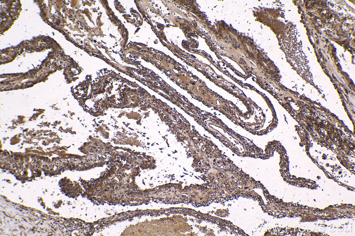 Immunohistochemical analysis of paraffin-embedded human renal cell carcinoma tissue slide using KHC1628 (PRKAA2 IHC Kit).