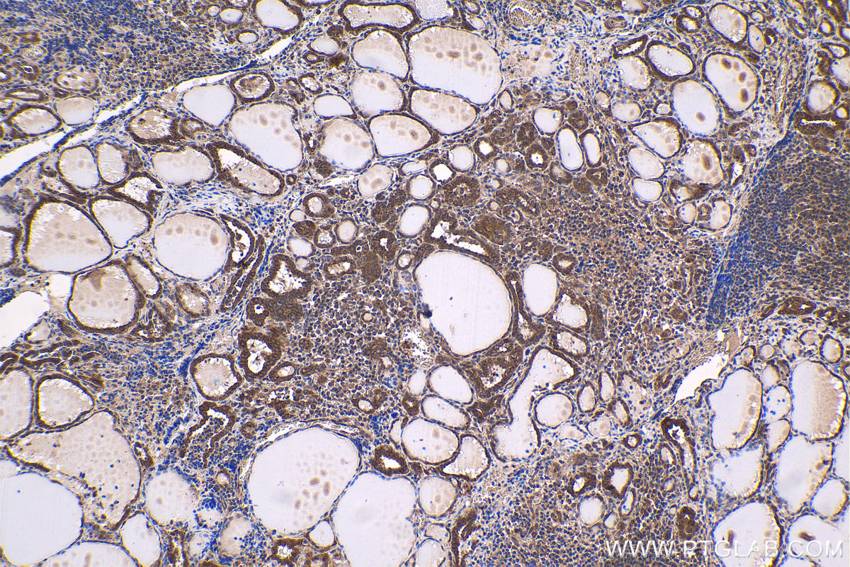 Immunohistochemical analysis of paraffin-embedded human thyroid cancer tissue slide using KHC1628 (PRKAA2 IHC Kit).