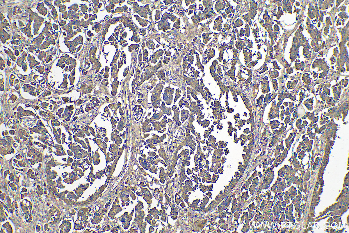 Immunohistochemical analysis of paraffin-embedded human colon cancer tissue slide using KHC0786 (PRKCI IHC Kit).