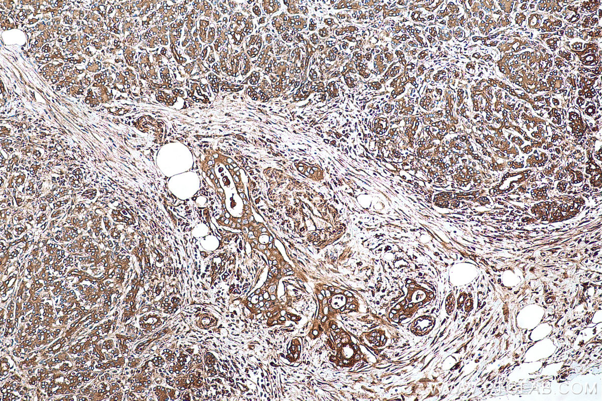 Immunohistochemical analysis of paraffin-embedded human pancreas cancer tissue slide using KHC0698 (PRKCSH IHC Kit).