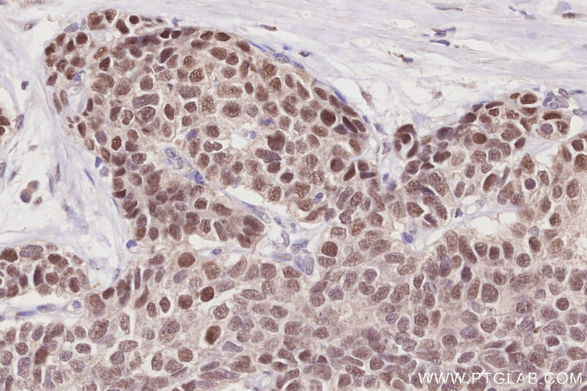 Immunohistochemical analysis of paraffin-embedded human stomach cancer tissue slide using KHC2835 (PRMT6 IHC Kit).