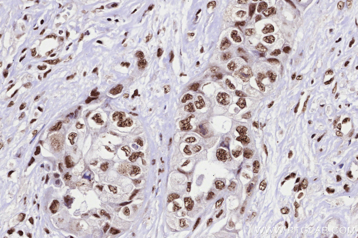 Immunohistochemical analysis of paraffin-embedded human pancreas cancer tissue slide using KHC3303 (PRPF31 IHC Kit).