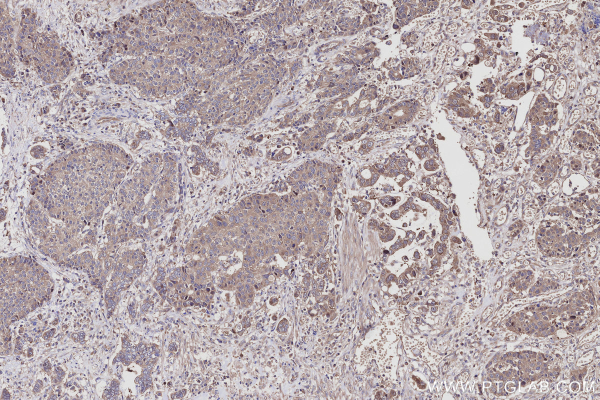 Immunohistochemical analysis of paraffin-embedded human stomach cancer tissue slide using KHC3076 (PRRC2C IHC Kit).