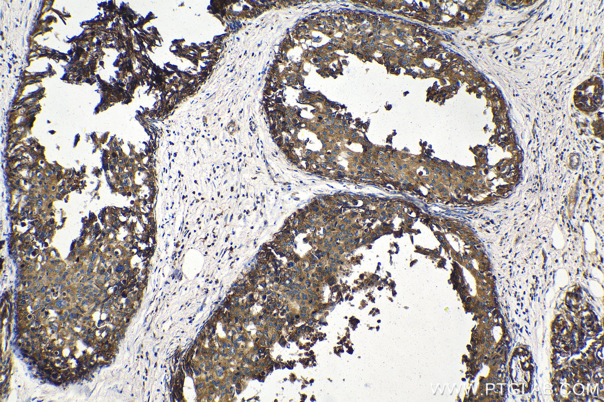 Immunohistochemical analysis of paraffin-embedded human breast cancer tissue slide using KHC1407 (PSAP IHC Kit).