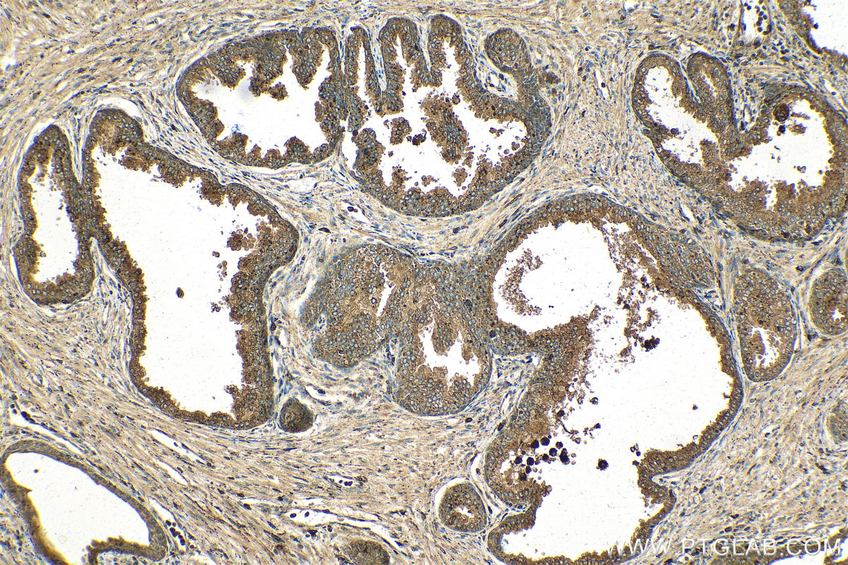 Immunohistochemical analysis of paraffin-embedded human prostate cancer tissue slide using KHC1407 (PSAP IHC Kit).