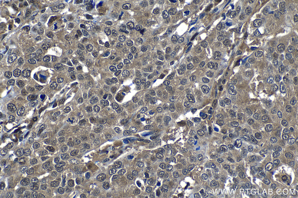 Immunohistochemical analysis of paraffin-embedded human ovary tumor tissue slide using KHC1305 (PSMA2 IHC Kit).