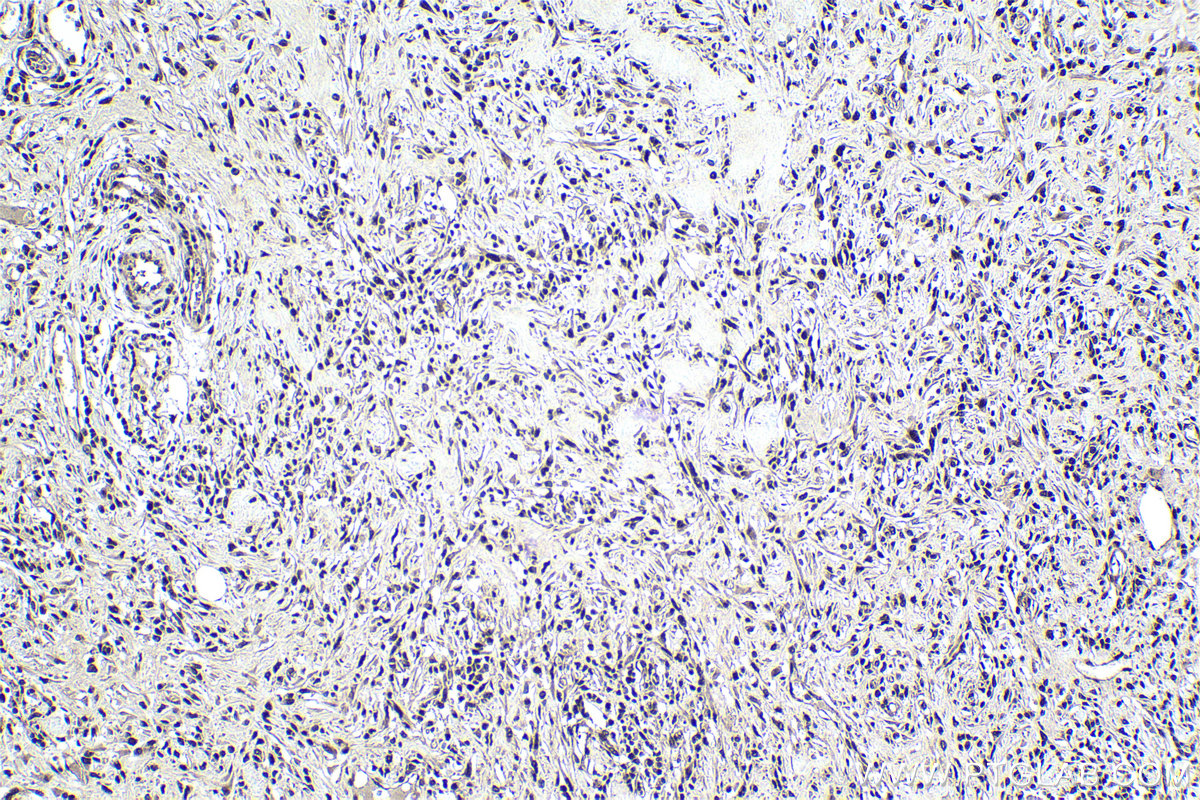 Immunohistochemical analysis of paraffin-embedded human colon cancer tissue slide using KHC0983 (PSMA8 IHC Kit).