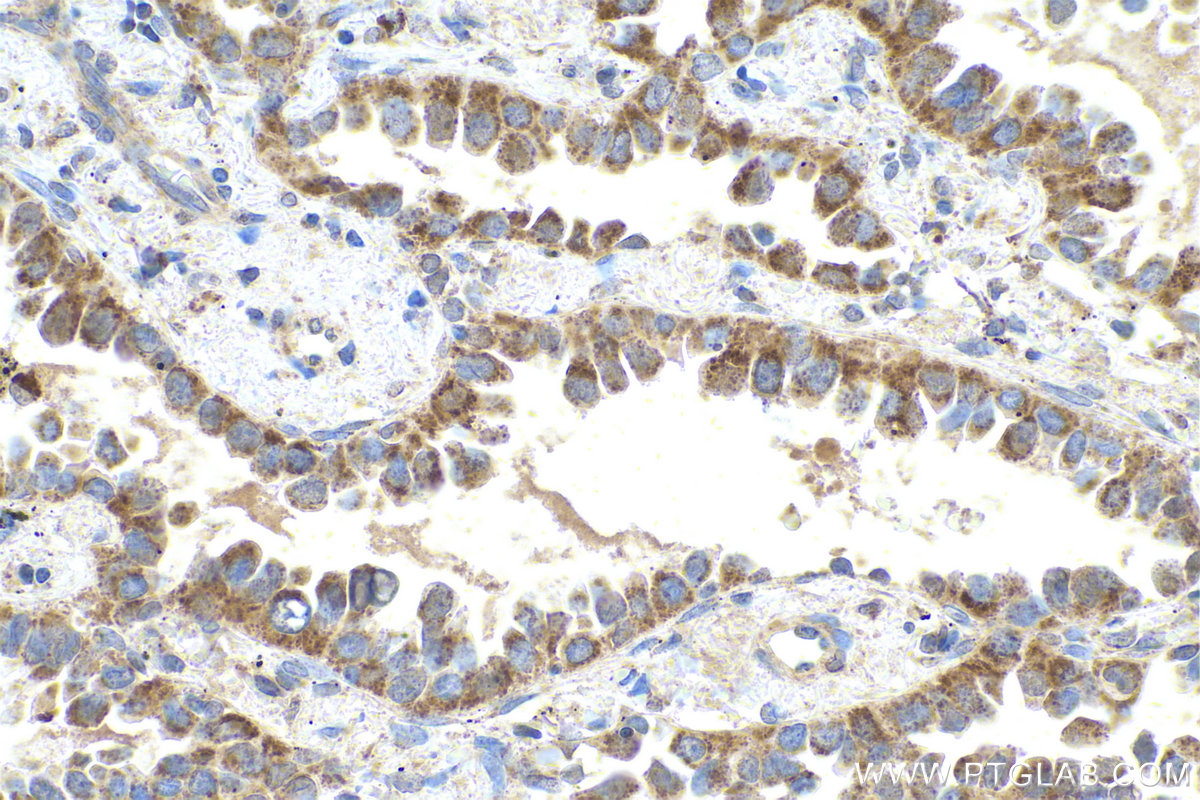 Immunohistochemical analysis of paraffin-embedded human lung cancer tissue slide using KHC0812 (PSMB7 IHC Kit).