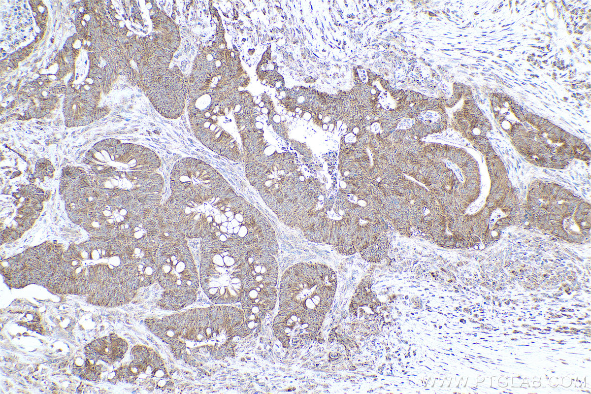 Immunohistochemical analysis of paraffin-embedded human colon cancer tissue slide using KHC0812 (PSMB7 IHC Kit).