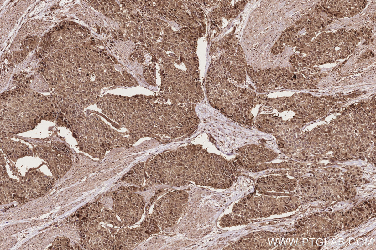 Immunohistochemical analysis of paraffin-embedded human stomach cancer tissue slide using KHC2839 (PSMD1 IHC Kit).