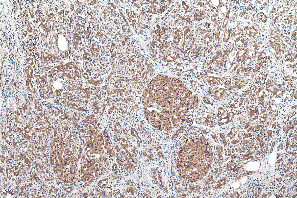 Immunohistochemical analysis of paraffin-embedded human pancreas cancer tissue slide using KHC0895 (PSMD13 IHC Kit).