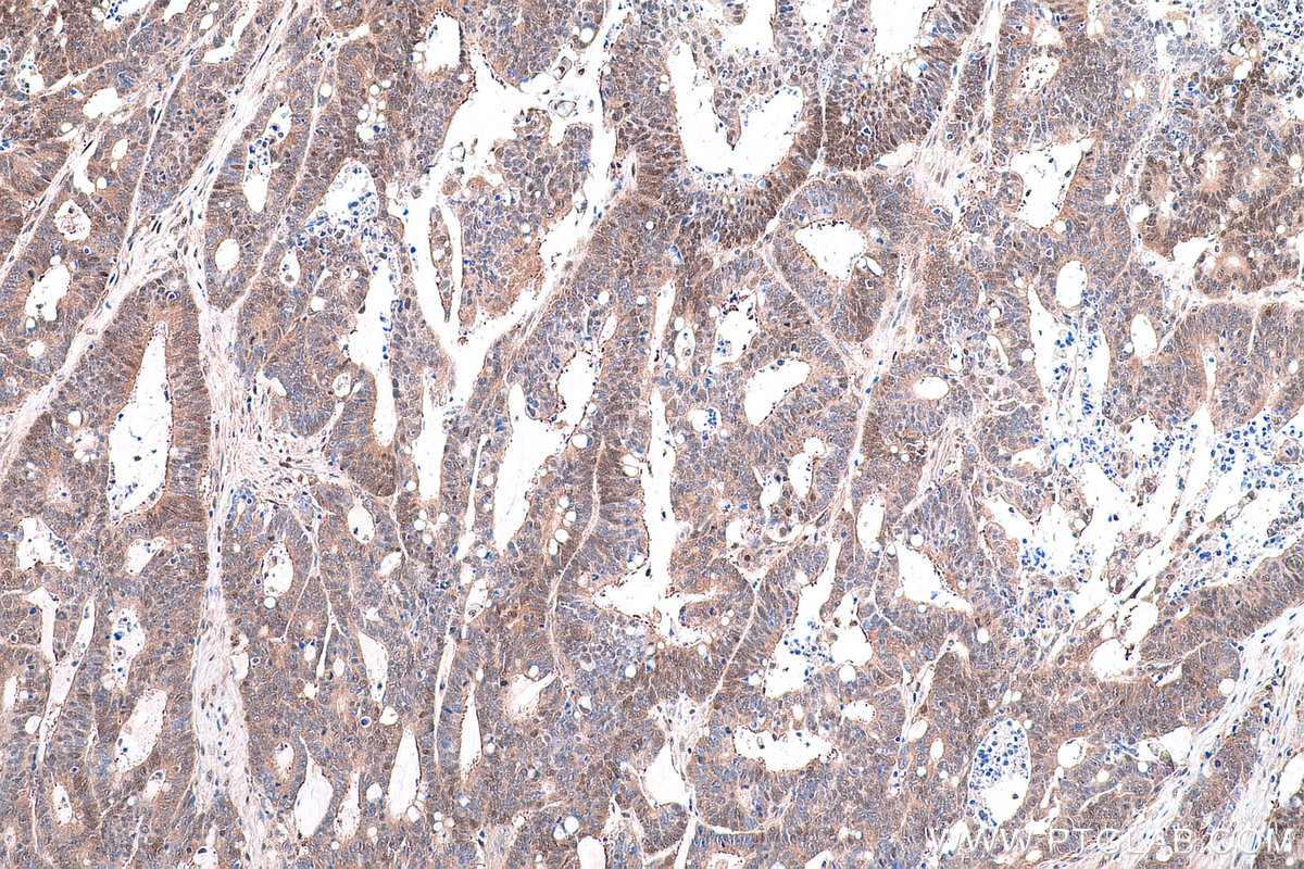 Immunohistochemical analysis of paraffin-embedded human colon cancer tissue slide using KHC0858 (PSMD5 IHC Kit).