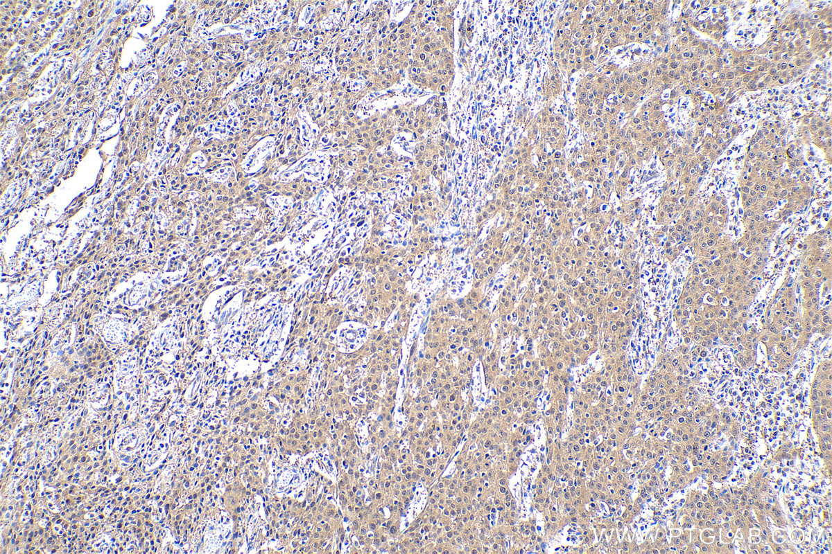 Immunohistochemical analysis of paraffin-embedded human cervical cancer tissue slide using KHC0943 (PSMD7 IHC Kit).