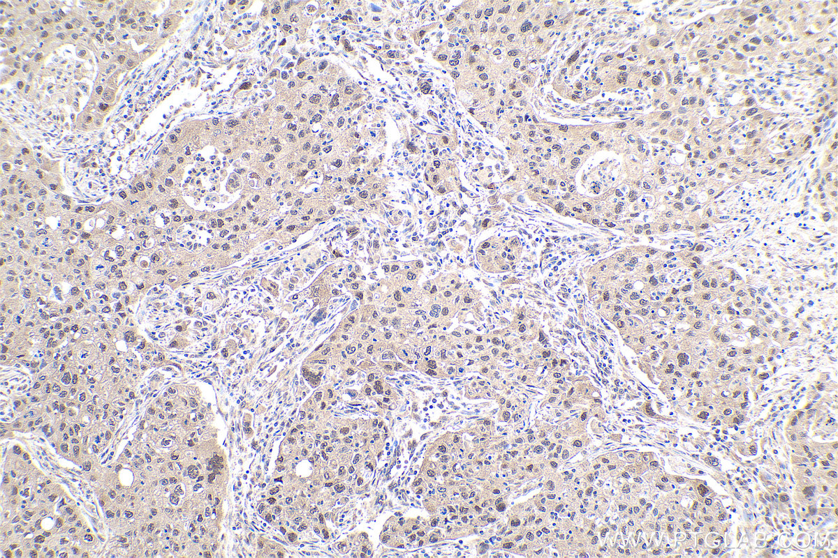 Immunohistochemical analysis of paraffin-embedded human lung cancer tissue slide using KHC0943 (PSMD7 IHC Kit).