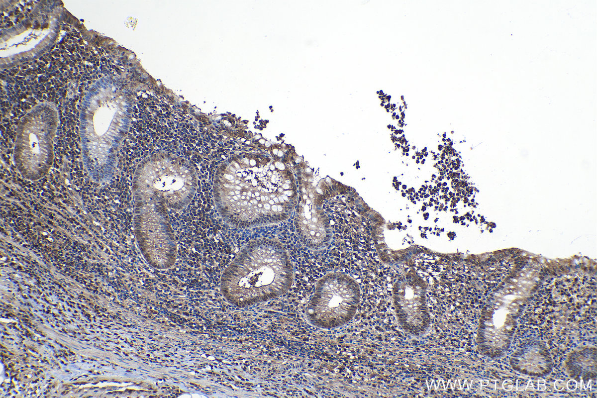 Immunohistochemical analysis of paraffin-embedded human appendicitis tissue slide using KHC1142 (PSME1 IHC Kit).