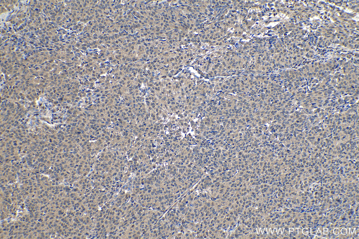 Immunohistochemical analysis of paraffin-embedded human stomach cancer tissue slide using KHC1142 (PSME1 IHC Kit).