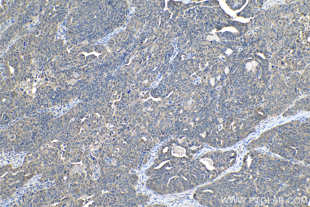 Immunohistochemical analysis of paraffin-embedded human ovary tumor tissue slide using KHC1186 (PTGES3 IHC Kit).