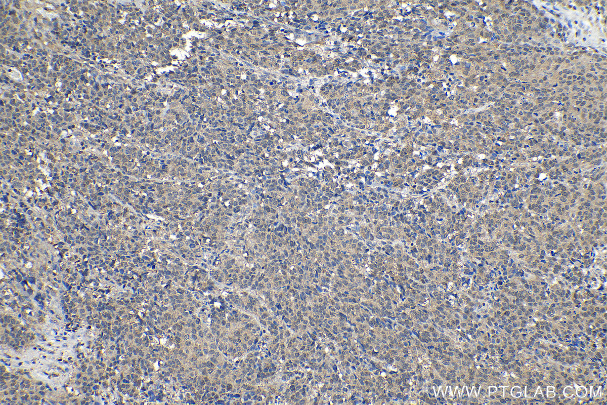 Immunohistochemical analysis of paraffin-embedded human stomach cancer tissue slide using KHC1186 (PTGES3 IHC Kit).