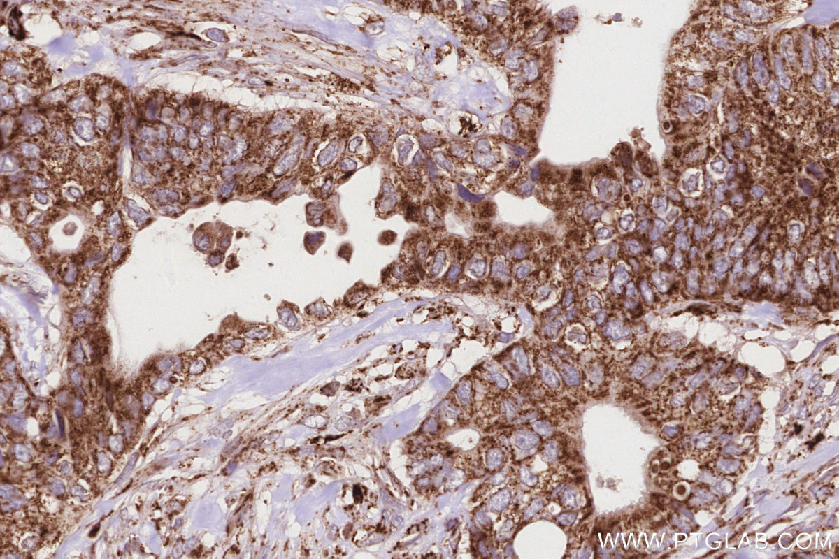 Immunohistochemical analysis of paraffin-embedded human rectal cancer tissue slide using KHC2838 (PTPIP51 IHC Kit).