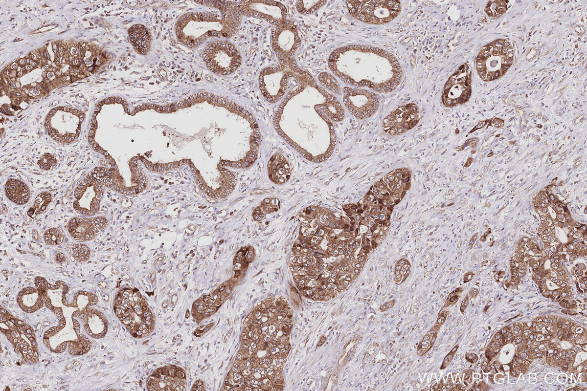 Immunohistochemical analysis of paraffin-embedded human pancreas cancer tissue slide using KHC2983 (PTPLAD1 IHC Kit). Immunohistochemical analysis of paraffin-embedded human pancreas cancer tissue slide using KHC2983 (PTPLAD1 IHC Kit).
