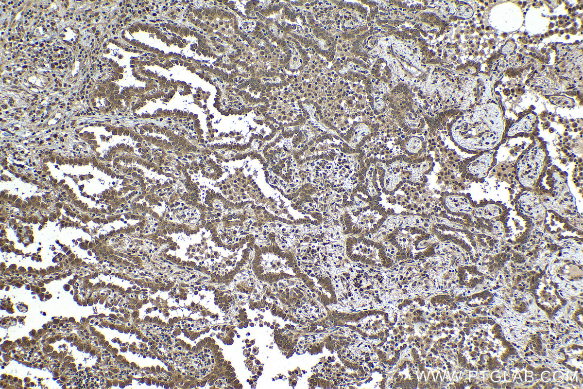 Immunohistochemical analysis of paraffin-embedded human lung cancer tissue slide using KHC1316 (PTPN2 IHC Kit).