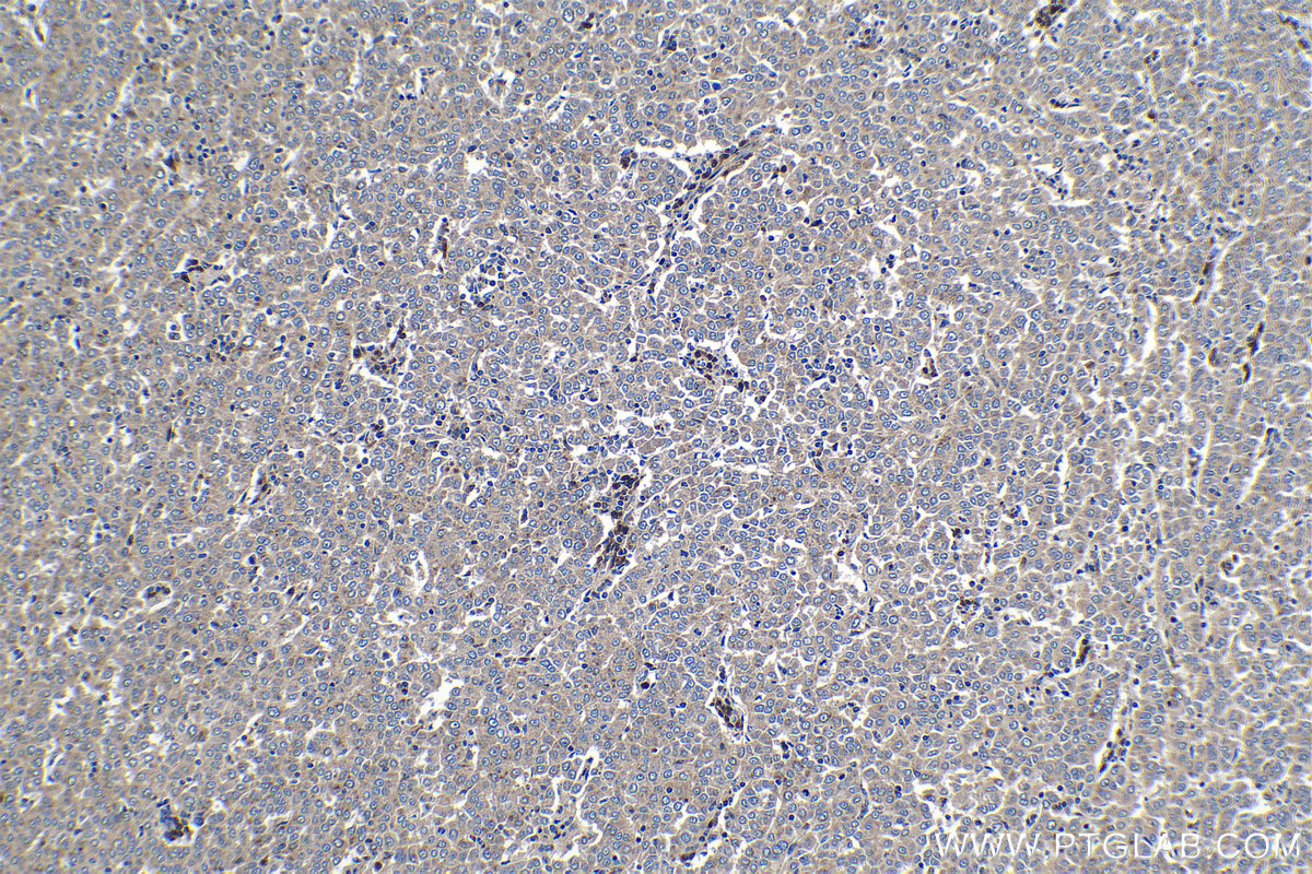 Immunohistochemical analysis of paraffin-embedded human ovary tumor tissue slide using KHC1316 (PTPN2 IHC Kit).