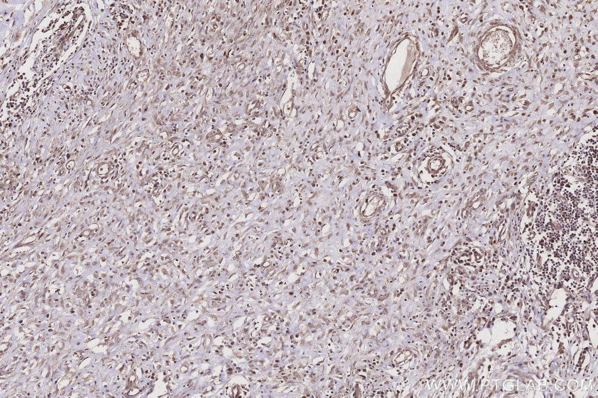 Immunohistochemical analysis of paraffin-embedded human colon cancer tissue slide using KHC3210 (PTPN9 IHC Kit).