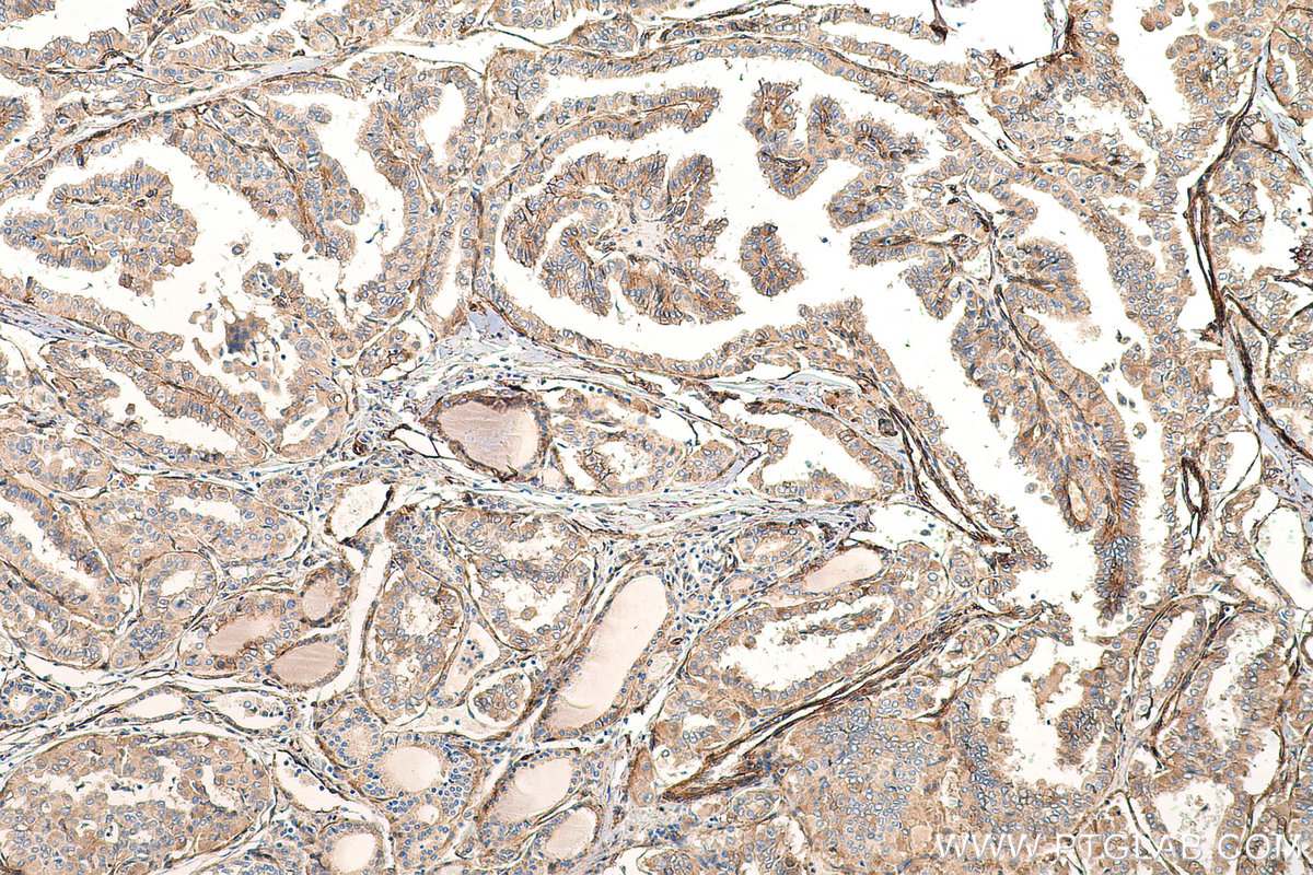 Immunohistochemical analysis of paraffin-embedded human thyroid cancer tissue slide using KHC0677 (PTRF IHC Kit).