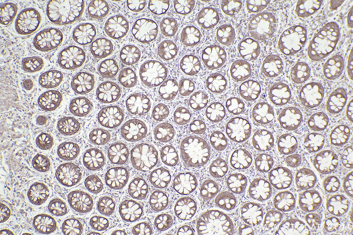 Immunohistochemical analysis of paraffin-embedded human rectal cancer tissue slide using KHC2515 (PUM1 IHC Kit).