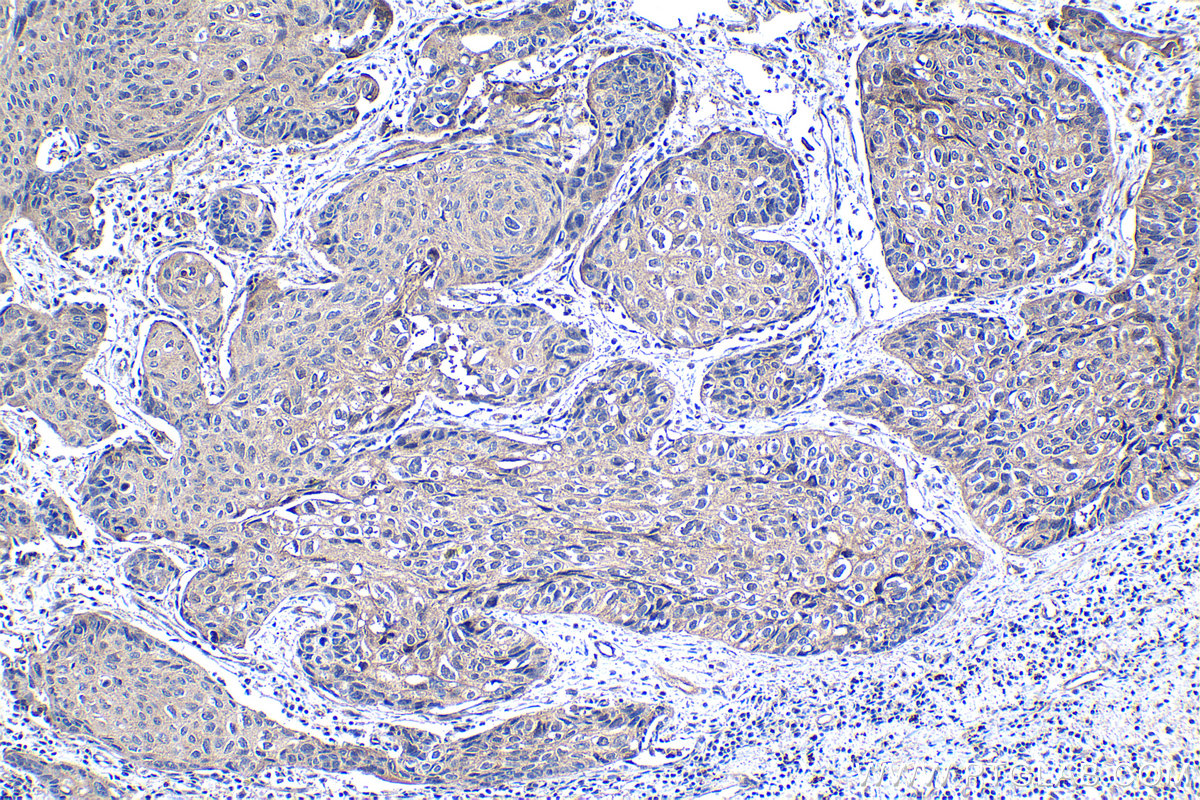 Immunohistochemical analysis of paraffin-embedded human lung cancer tissue slide using KHC1239 (PVR IHC Kit).