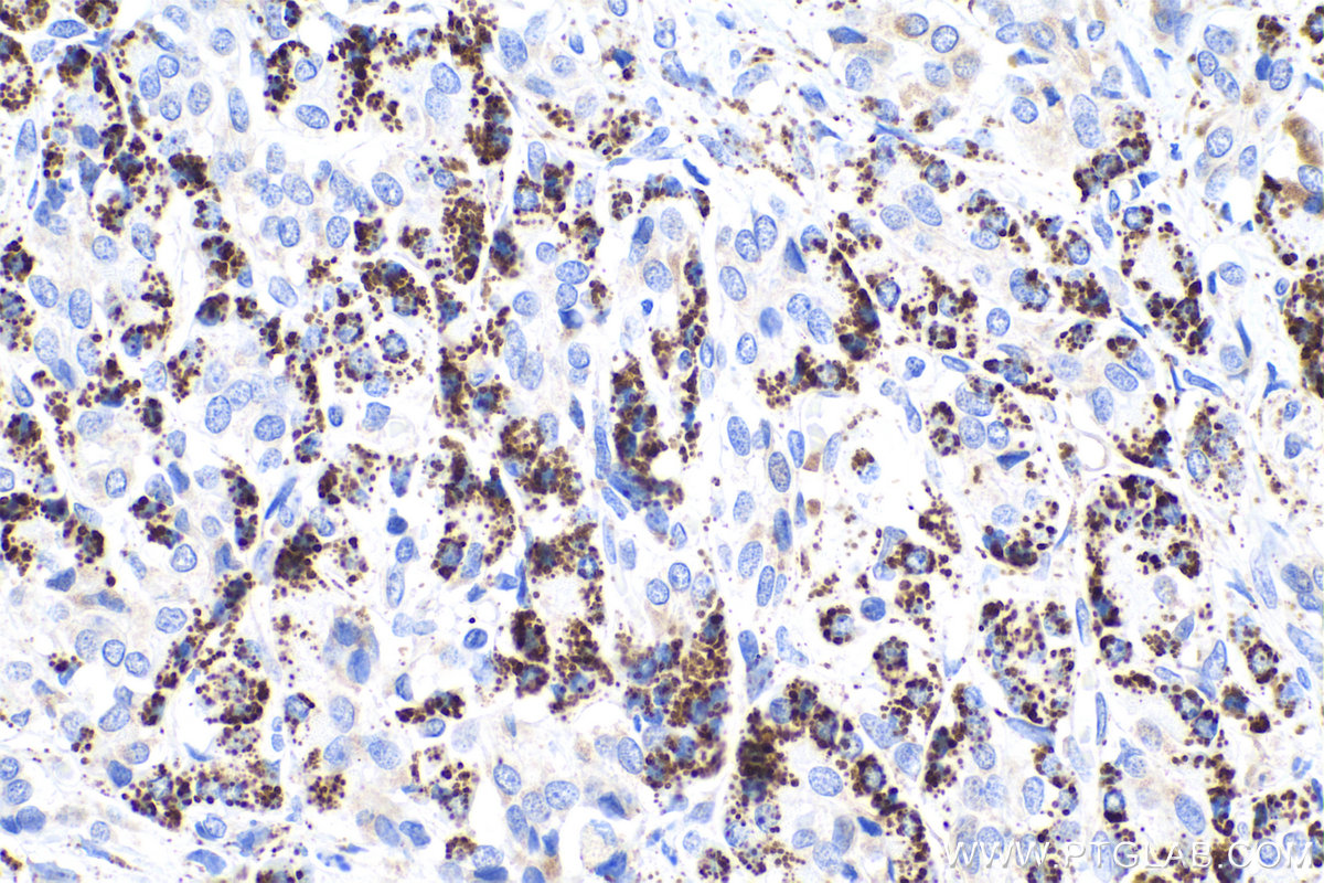 Immunohistochemical analysis of paraffin-embedded human pancreas cancer tissue slide using KHC0833 (PYCR1 IHC Kit).