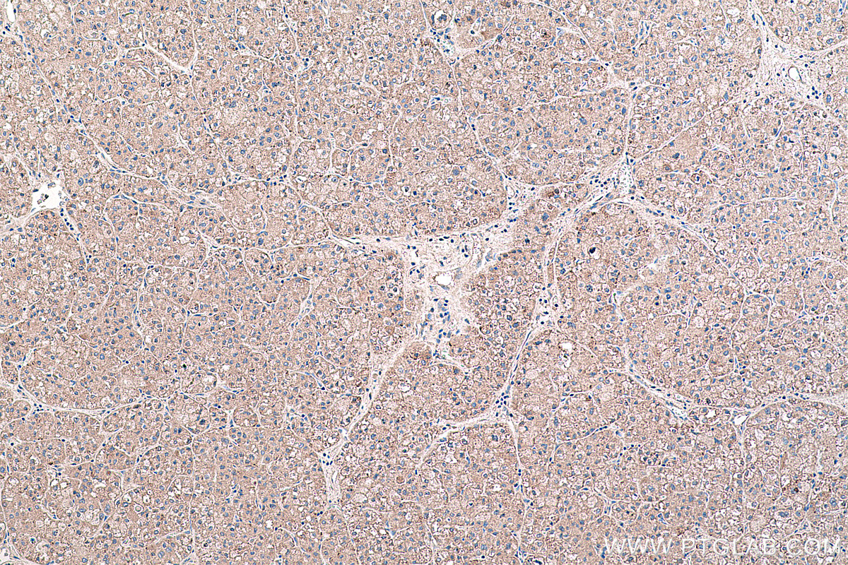 Immunohistochemical analysis of paraffin-embedded human liver cancer tissue slide using KHC0230 (Perilipin 5 IHC Kit).