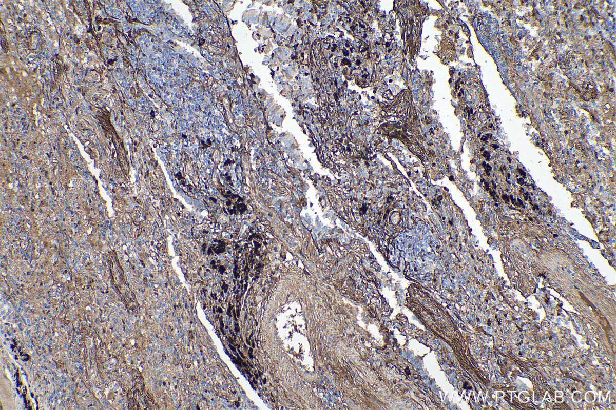 Immunohistochemical analysis of paraffin-embedded human lung cancer tissue slide using KHC0130 (Periostin IHC Kit).