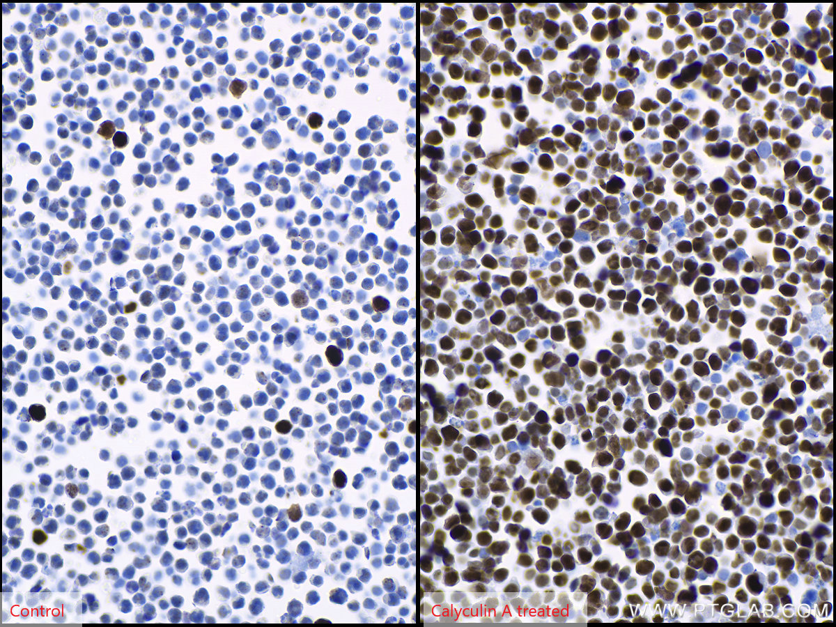 Immunohistochemical analysis of paraffin-embedded Jurkat (left) and calyculin A treated Jurkat (right) cells slide using KHC1439 (Phospho-Histone H3 (Ser10) IHC Kit).