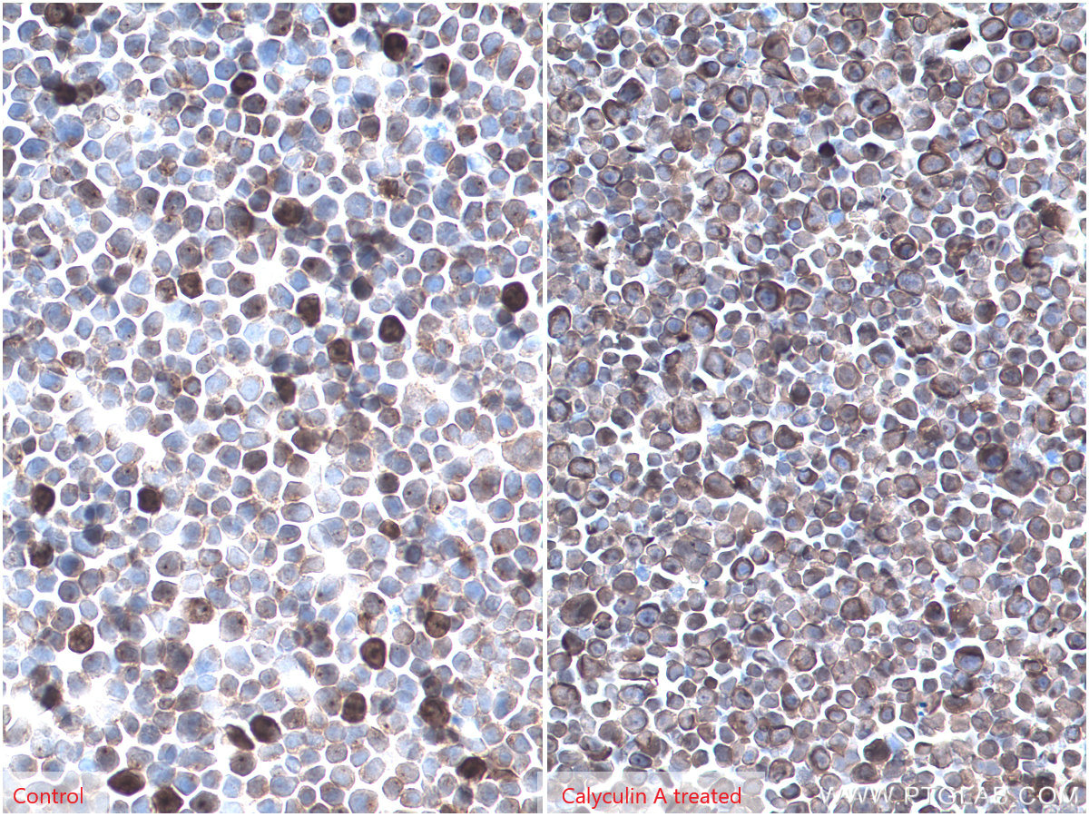 Immunohistochemical analysis of paraffin-embedded Jurkat (left) and calyculin A treated Jurkat (right) cells slide using KHC0292 (Phospho-RPS6KA1 (Ser380)  IHC Kit).