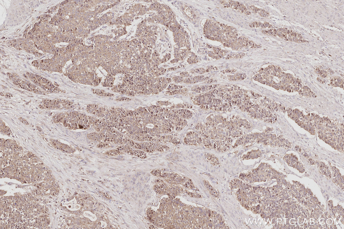 Immunohistochemical analysis of paraffin-embedded human stomach cancer tissue slide using KHC3069 (Plakophilin 3 IHC Kit).