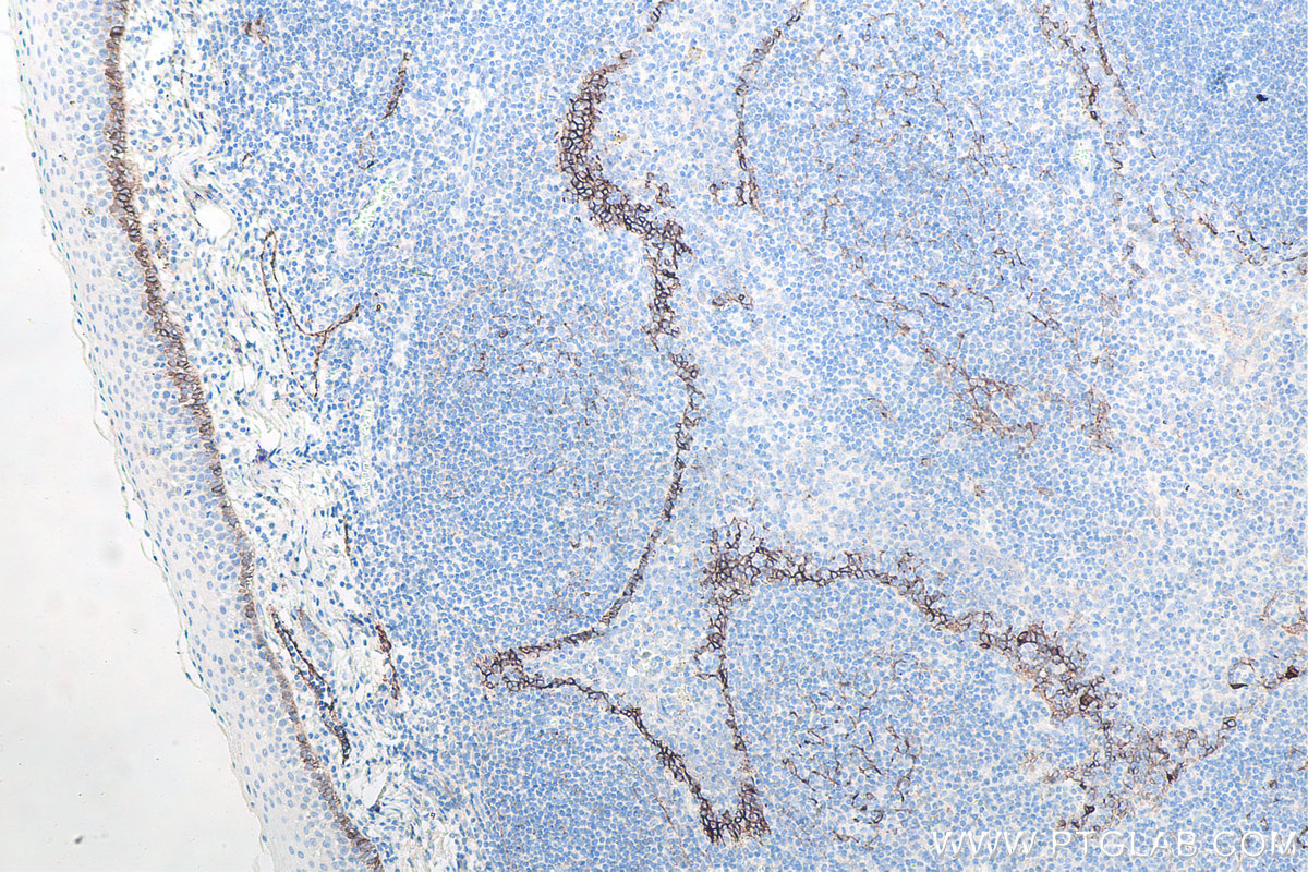 Immunohistochemical analysis of paraffin-embedded human tonsillitis tissue slide using KHC0092 (Podoplanin IHC Kit).